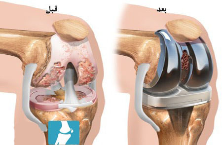 تعویض کامل مفصل زانو