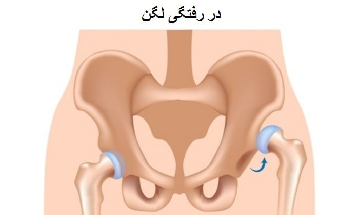 دررفتگی لگن چگونه درمان میشود؟ فیزیوتراپی و بریس دررفتگی لگن