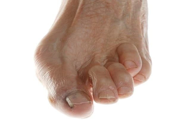 درمان بد شکلی انگشتان پا با فیزیوتراپی، ورزش، اسپلینت و جراحی