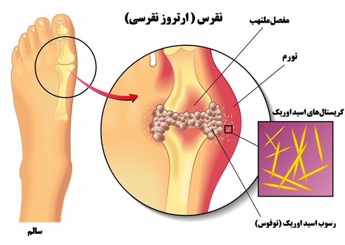 درمان بیماری نقرس پا