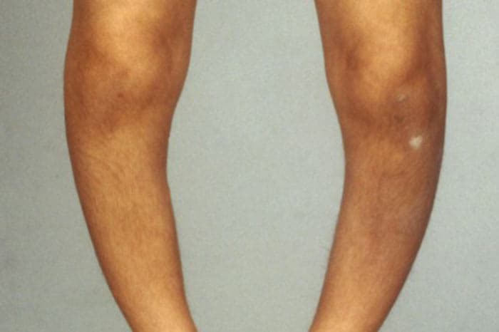 درمان زانو و پای پرانتزی