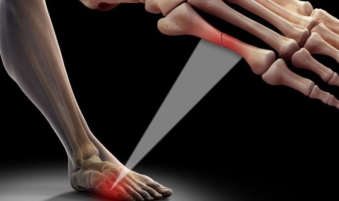 شکستگی استخوان کف پا (متاتارس) بدون جراحی قابل درمان است؟