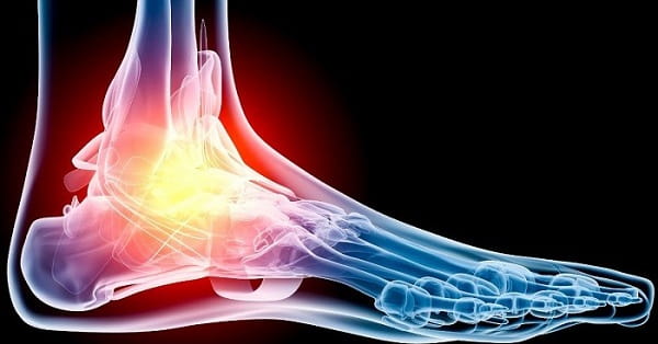 علت پا درد چیست؟ علت درد ماهیچه، عصب، استخوان و تاندون پا