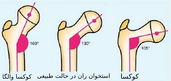 کوکسا والگا (برون خمیدگی لگن) با فیزیوتراپی و ورزش قابل درمان است؟